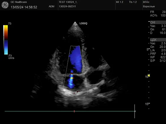GE HealthCare Logiq P10 ультразвуковой аппарат
