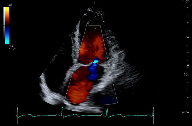 GE Logiq Fortis аппарат УЗИ