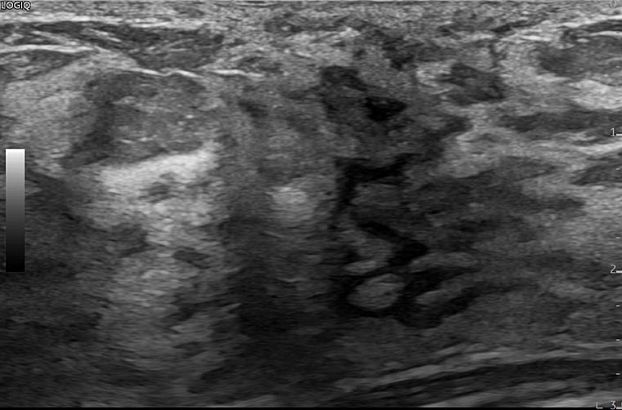 GE Logiq Fortis аппарат УЗИ