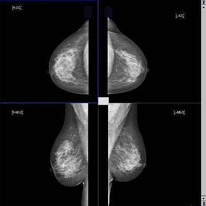 Цифровая маммографическая система Siemens Mammomat Inspiration