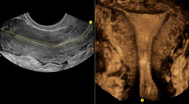 GE Logiq Fortis аппарат УЗИ