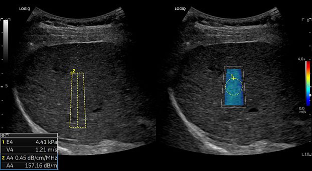 GE Logiq Fortis аппарат УЗИ