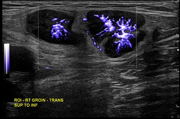 GE Logiq Fortis аппарат УЗИ