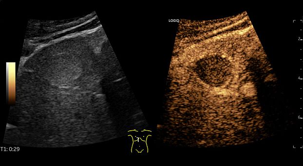 GE Logiq Fortis аппарат УЗИ