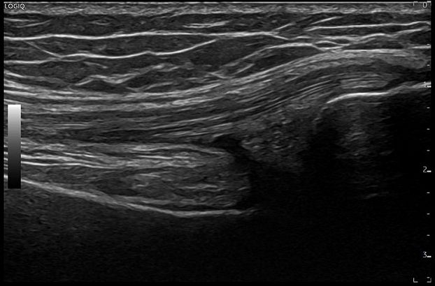 GE Logiq Fortis аппарат УЗИ